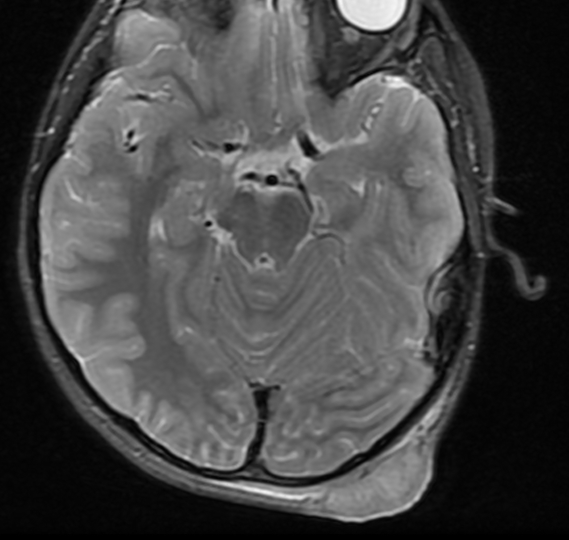 What Is This Rapidly Growing Scalp Lesion on a 7YearOld? Consultant360